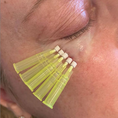 il filo assorbibile di 25mm Pdo Pcl solleva il tipo cannula smussata di W per perdita di sotto del volume dell'occhio