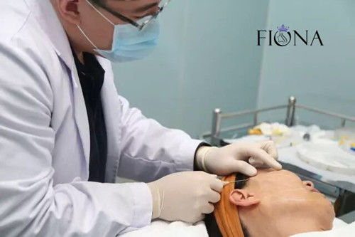 il fronte Non chirurgico del filo del dente di lifting facciale PDO PCL PLACL solleva 360 la cannula di 4D 6D 12D W