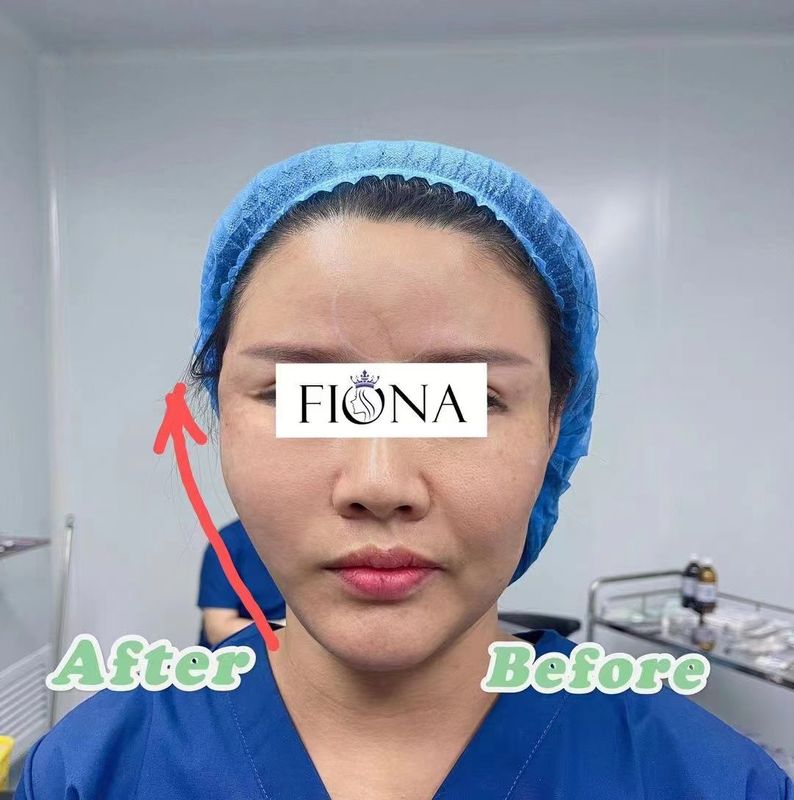 Il filo assorbibile del dente di PDO solleva il gas di EO sterilizzato per gli occhi di Fox dell'ascensore del sopracciglio